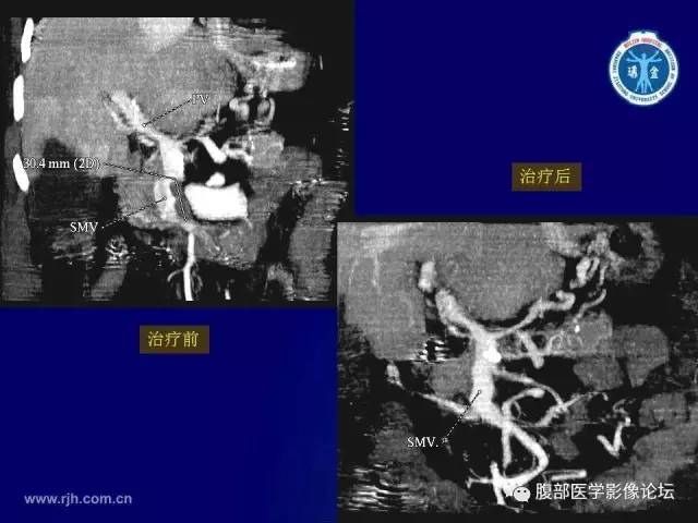 【PPT】急性肠系膜血管梗塞CT诊断