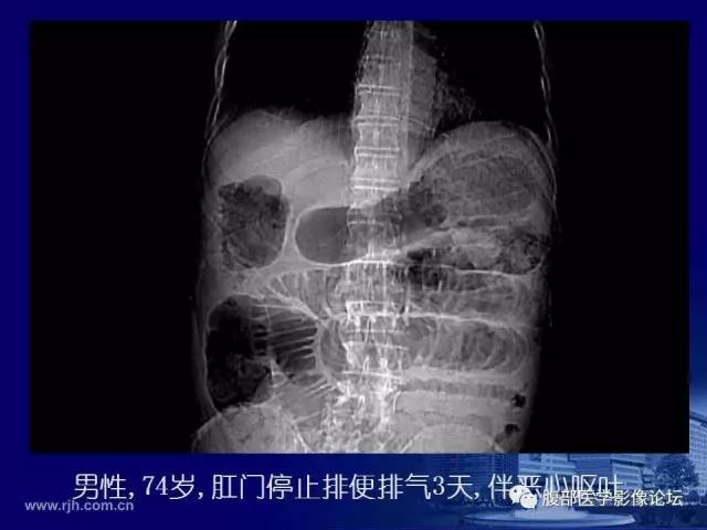 【PPT】急性肠系膜血管梗塞CT诊断