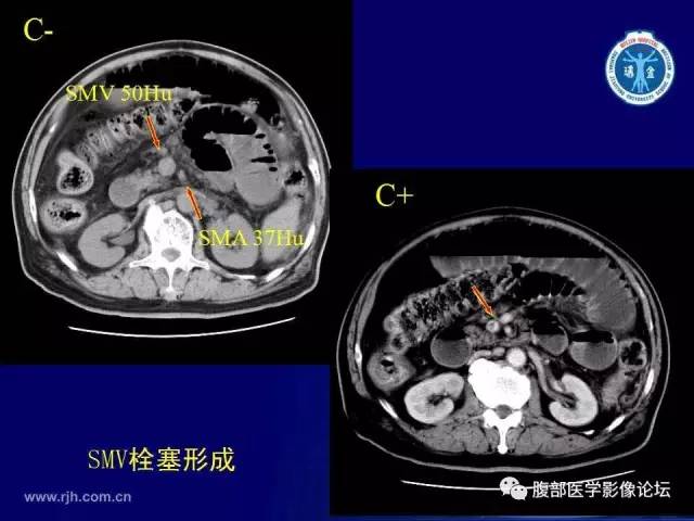 【PPT】急性肠系膜血管梗塞CT诊断