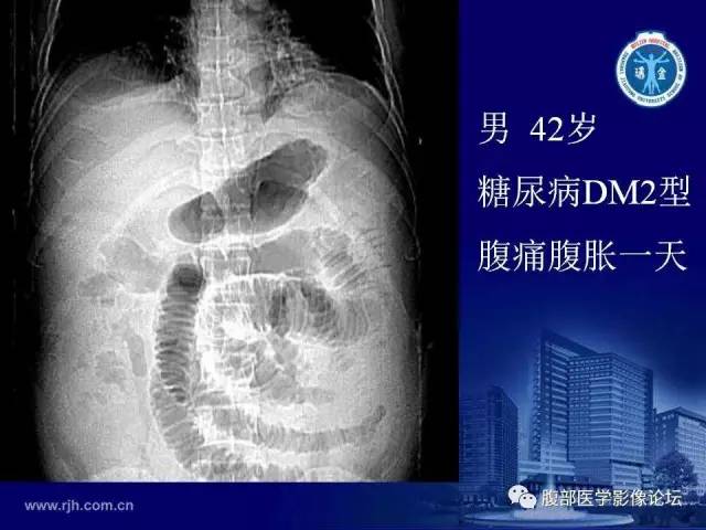 【PPT】急性肠系膜血管梗塞CT诊断