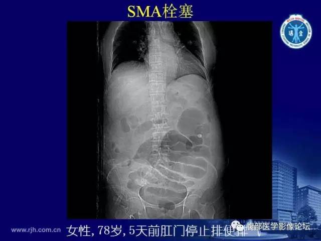 【PPT】急性肠系膜血管梗塞CT诊断