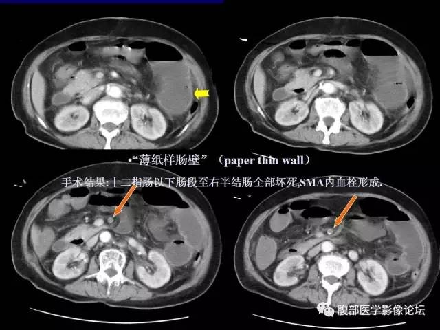 【PPT】急性肠系膜血管梗塞CT诊断