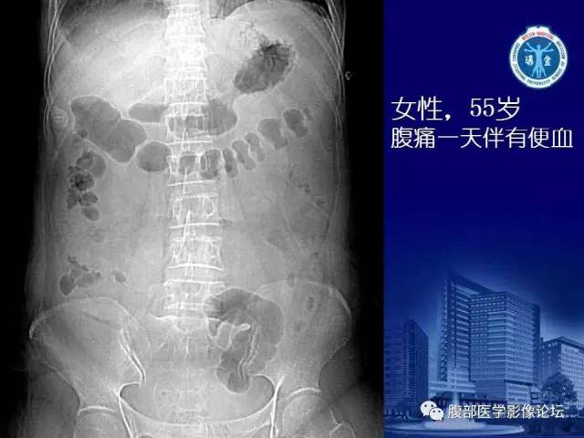 【PPT】急性肠系膜血管梗塞CT诊断