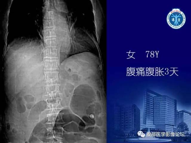 【PPT】急性肠系膜血管梗塞CT诊断