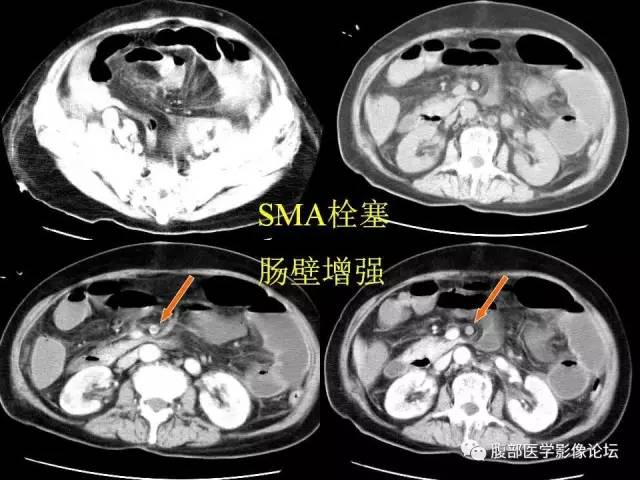 【PPT】急性肠系膜血管梗塞CT诊断