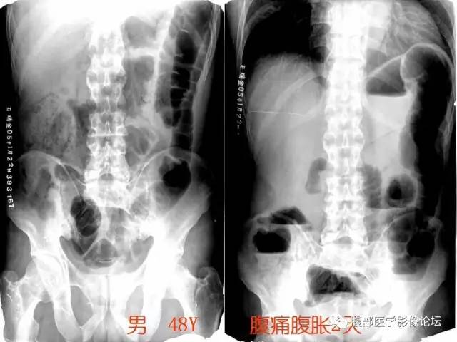 【PPT】急性肠系膜血管梗塞CT诊断