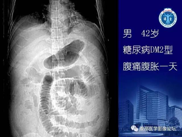 【PPT】急性肠系膜血管梗塞CT诊断