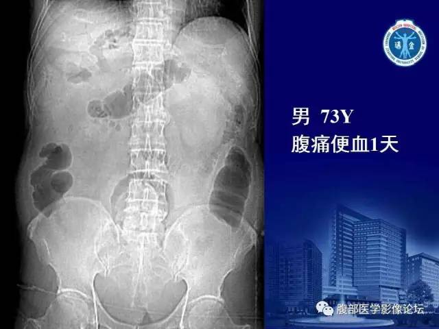 【PPT】急性肠系膜血管梗塞CT诊断