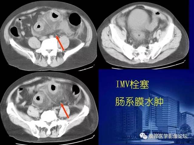 【PPT】急性肠系膜血管梗塞CT诊断