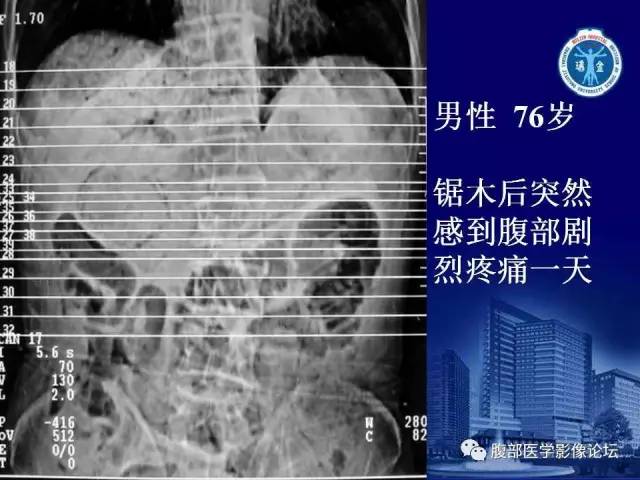 【PPT】急性肠系膜血管梗塞CT诊断