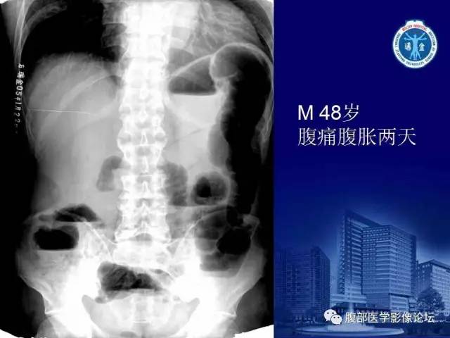 【PPT】急性肠系膜血管梗塞CT诊断
