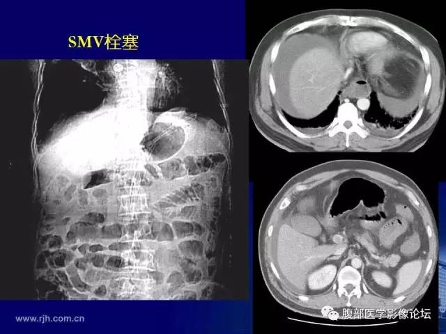 【PPT】急性肠系膜血管梗塞CT诊断