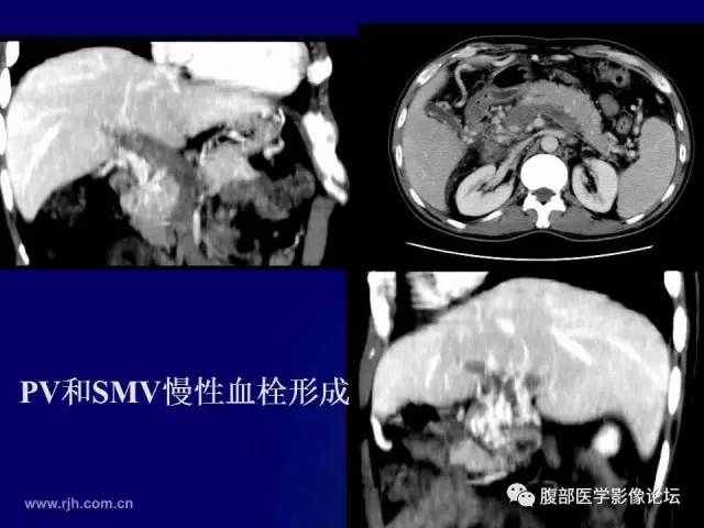 【PPT】急性肠系膜血管梗塞CT诊断