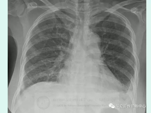 【病例】POEMS综合征一例CT