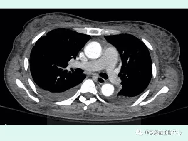 【病例】POEMS综合征一例CT