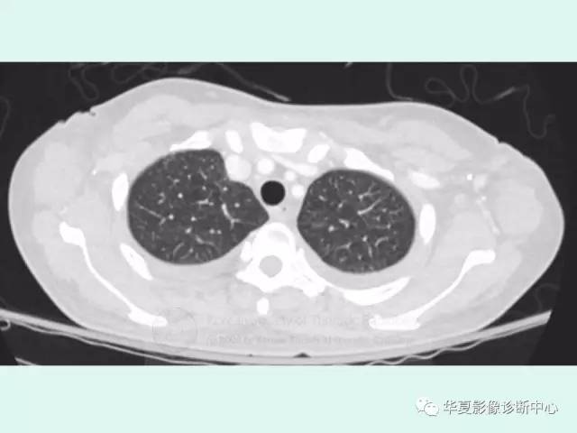【病例】POEMS综合征一例CT