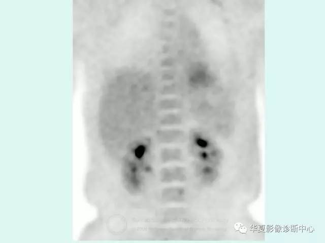 【病例】POEMS综合征一例CT
