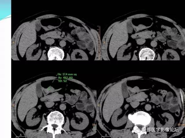 【病例】胃炎性纤维性息肉1例CT 【病例】胃炎性纤维性息肉1例CT