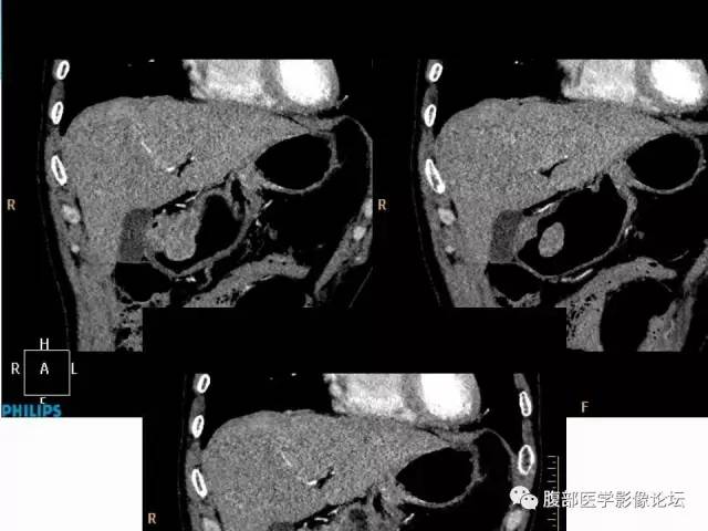 【病例】胃炎性纤维性息肉1例CT 【病例】胃炎性纤维性息肉1例CT