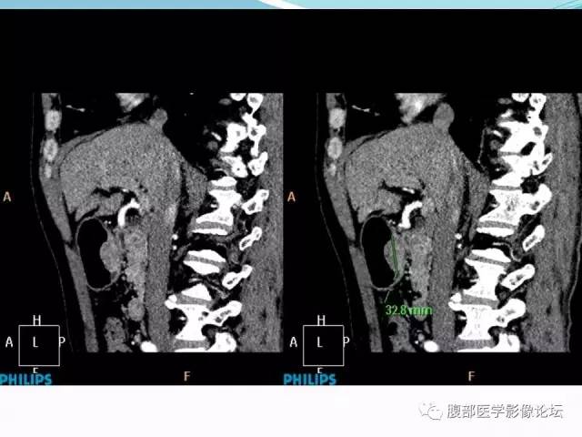 【病例】胃炎性纤维性息肉1例CT 【病例】胃炎性纤维性息肉1例CT