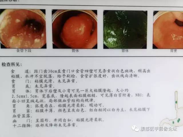 【病例】胃炎性纤维性息肉1例CT 【病例】胃炎性纤维性息肉1例CT