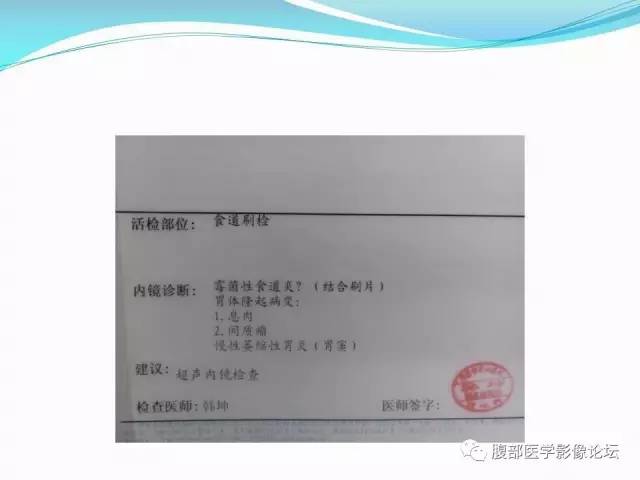 【病例】胃炎性纤维性息肉1例CT 【病例】胃炎性纤维性息肉1例CT