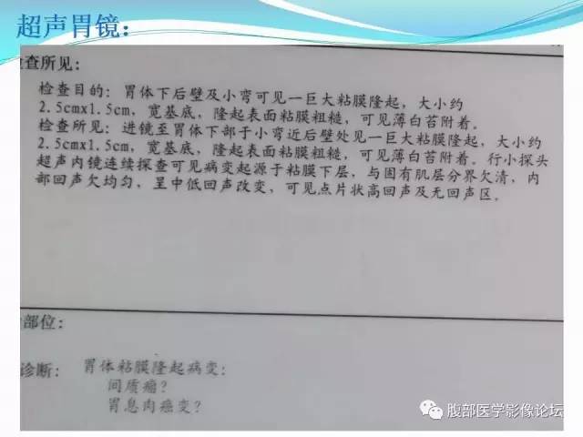 【病例】胃炎性纤维性息肉1例CT 【病例】胃炎性纤维性息肉1例CT