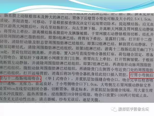 【病例】胃炎性纤维性息肉1例CT 【病例】胃炎性纤维性息肉1例CT