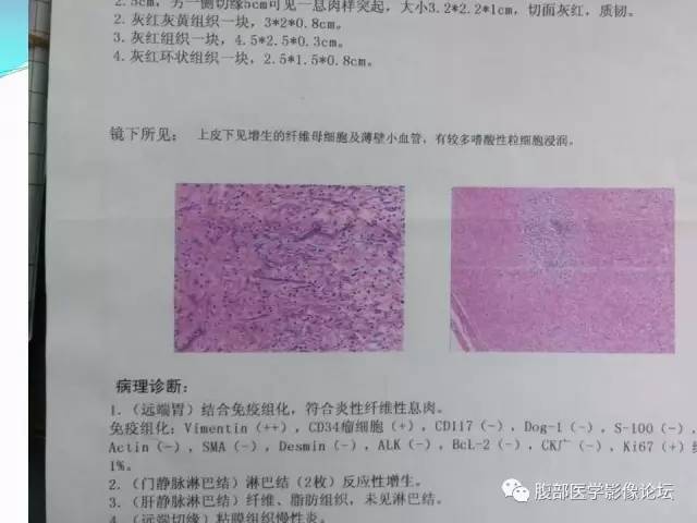 【病例】胃炎性纤维性息肉1例CT 【病例】胃炎性纤维性息肉1例CT