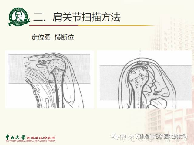 【PPT】肩关节解剖及常见病的MRI诊断