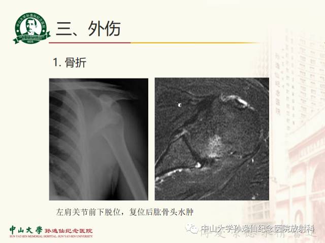 【PPT】肩关节解剖及常见病的MRI诊断