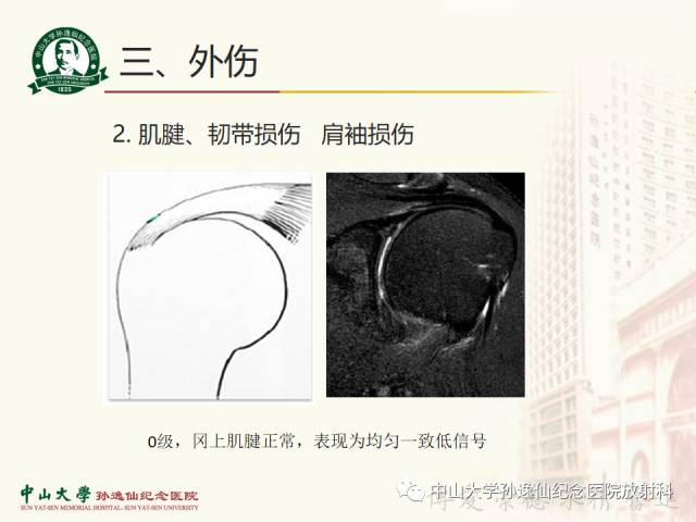 【PPT】肩关节解剖及常见病的MRI诊断