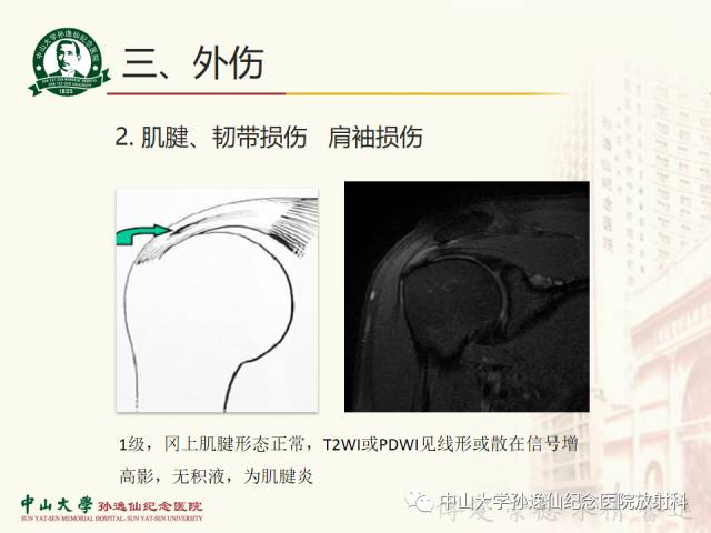 【PPT】肩关节解剖及常见病的MRI诊断