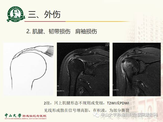 【PPT】肩关节解剖及常见病的MRI诊断