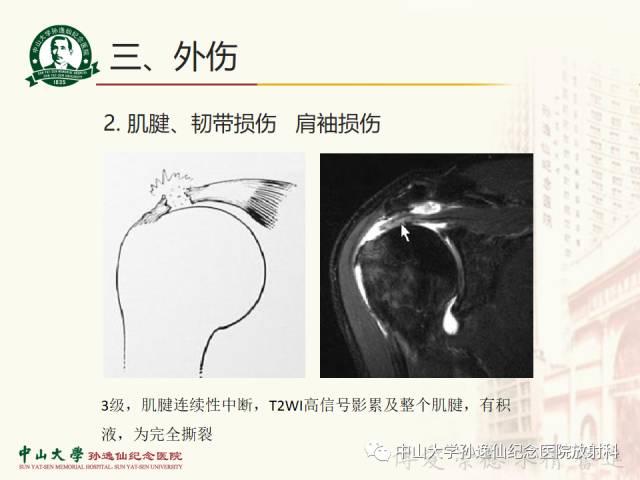 【PPT】肩关节解剖及常见病的MRI诊断