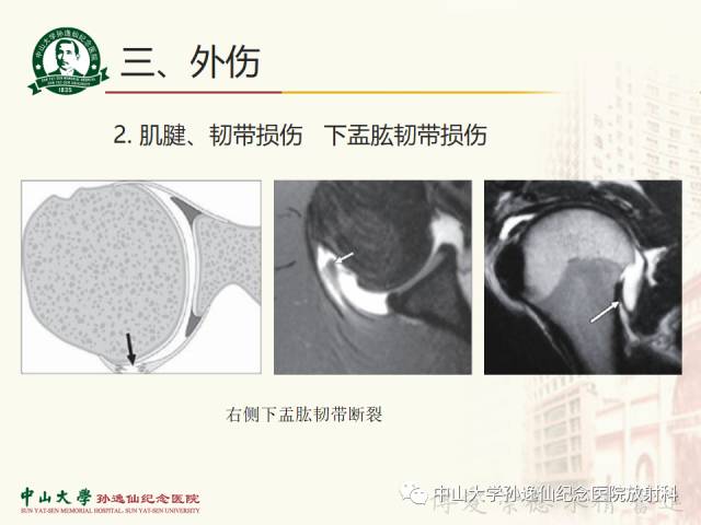 【PPT】肩关节解剖及常见病的MRI诊断