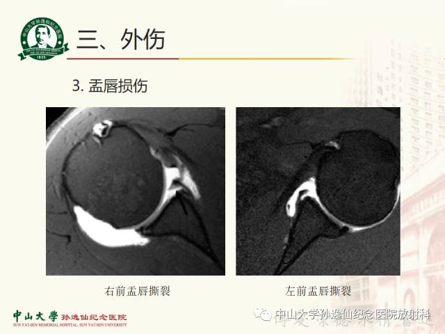 【PPT】肩关节解剖及常见病的MRI诊断