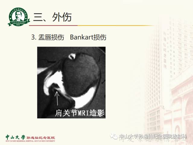 【PPT】肩关节解剖及常见病的MRI诊断