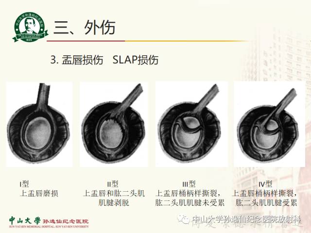 【PPT】肩关节解剖及常见病的MRI诊断