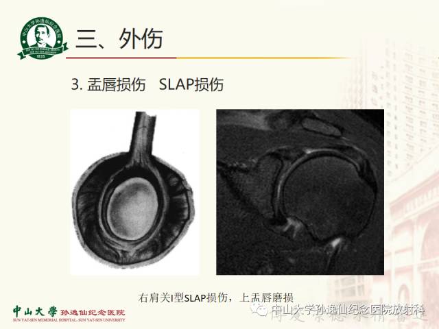 【PPT】肩关节解剖及常见病的MRI诊断