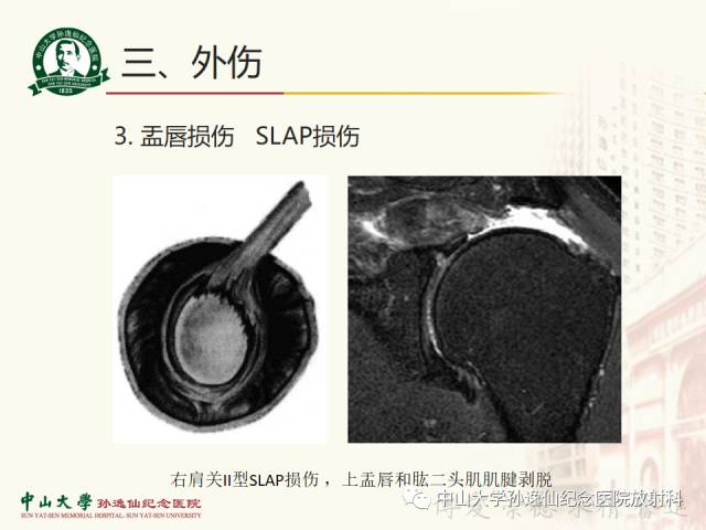 【PPT】肩关节解剖及常见病的MRI诊断