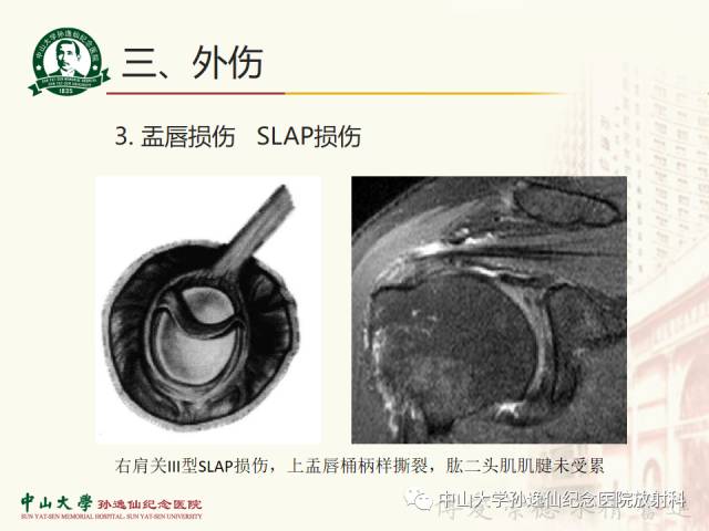 【PPT】肩关节解剖及常见病的MRI诊断