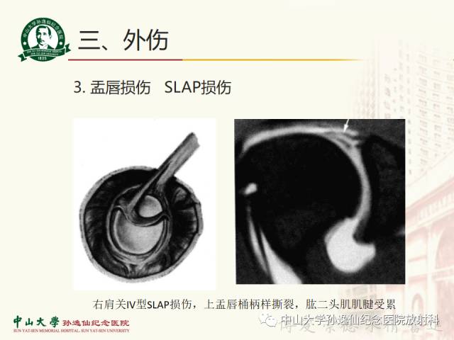 【PPT】肩关节解剖及常见病的MRI诊断