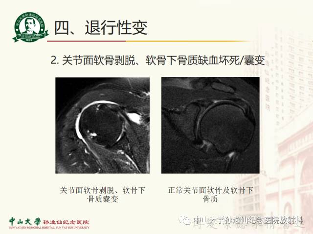 【PPT】肩关节解剖及常见病的MRI诊断