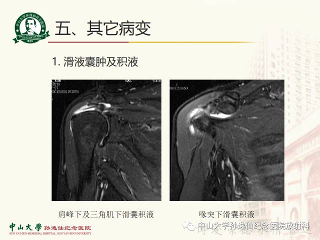 【PPT】肩关节解剖及常见病的MRI诊断