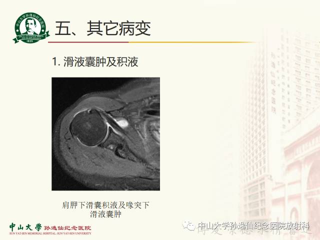 【PPT】肩关节解剖及常见病的MRI诊断