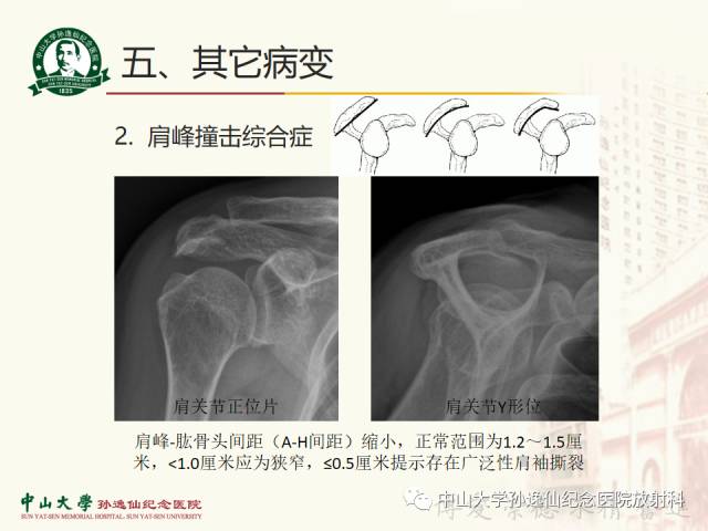 【PPT】肩关节解剖及常见病的MRI诊断