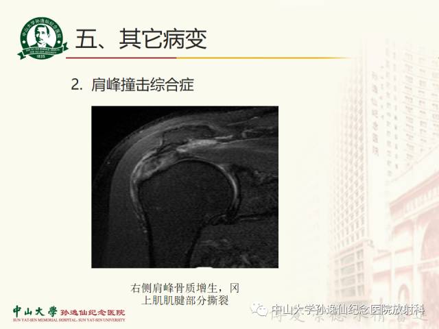 【PPT】肩关节解剖及常见病的MRI诊断