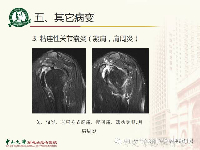 【PPT】肩关节解剖及常见病的MRI诊断