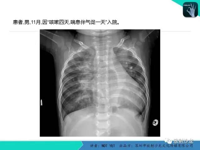 【病例】纵膈疝1例X线CT影像表现